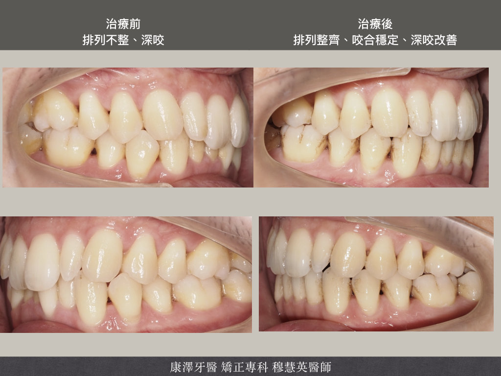 【矯正專欄】理想咬合的秘密:牙齒大小與數量的關鍵影響 【矯正專欄】理想咬合的秘密:牙齒大小與數量的關鍵影響