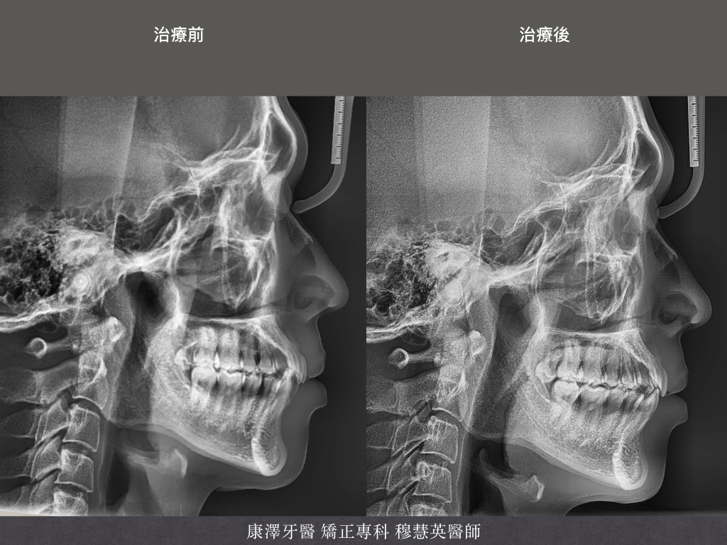 【矯正專欄】理想咬合的秘密:牙齒大小與數量的關鍵影響 【矯正專欄】理想咬合的秘密:牙齒大小與數量的關鍵影響
