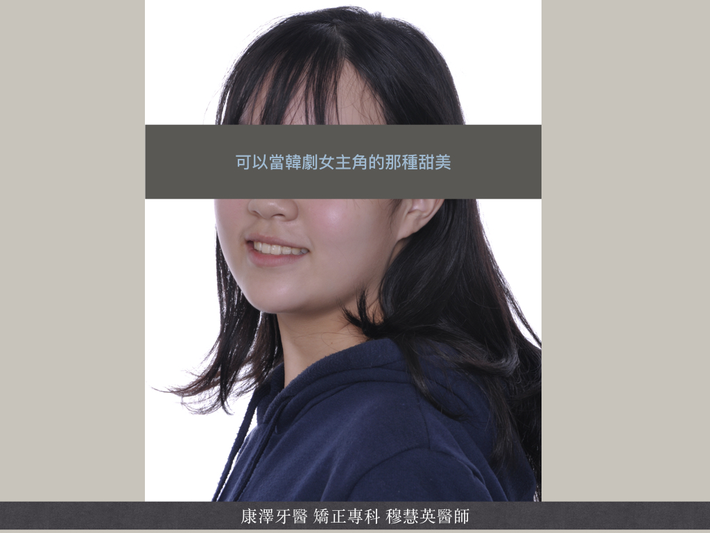 輕微牙齒不整齊?別小看矯正帶來的驚人改變! 輕微牙齒不整齊?別小看矯正帶來的驚人改變!