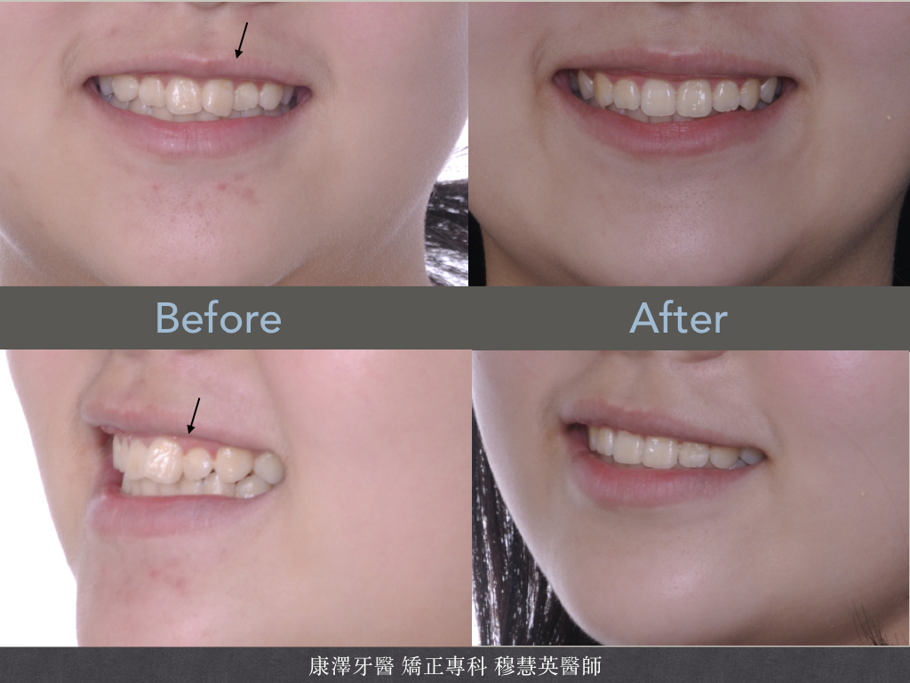 輕微牙齒不整齊?別小看矯正帶來的驚人改變! 輕微牙齒不整齊?別小看矯正帶來的驚人改變!