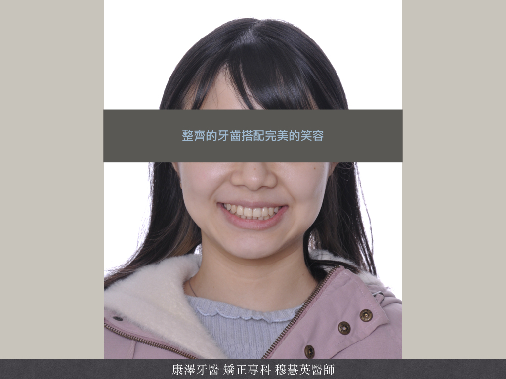 輕微牙齒不整齊?別小看矯正帶來的驚人改變! 輕微牙齒不整齊?別小看矯正帶來的驚人改變!