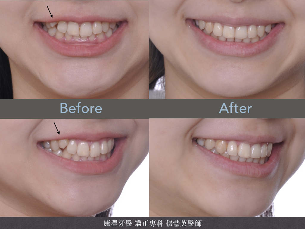 輕微牙齒不整齊?別小看矯正帶來的驚人改變! 輕微牙齒不整齊?別小看矯正帶來的驚人改變!