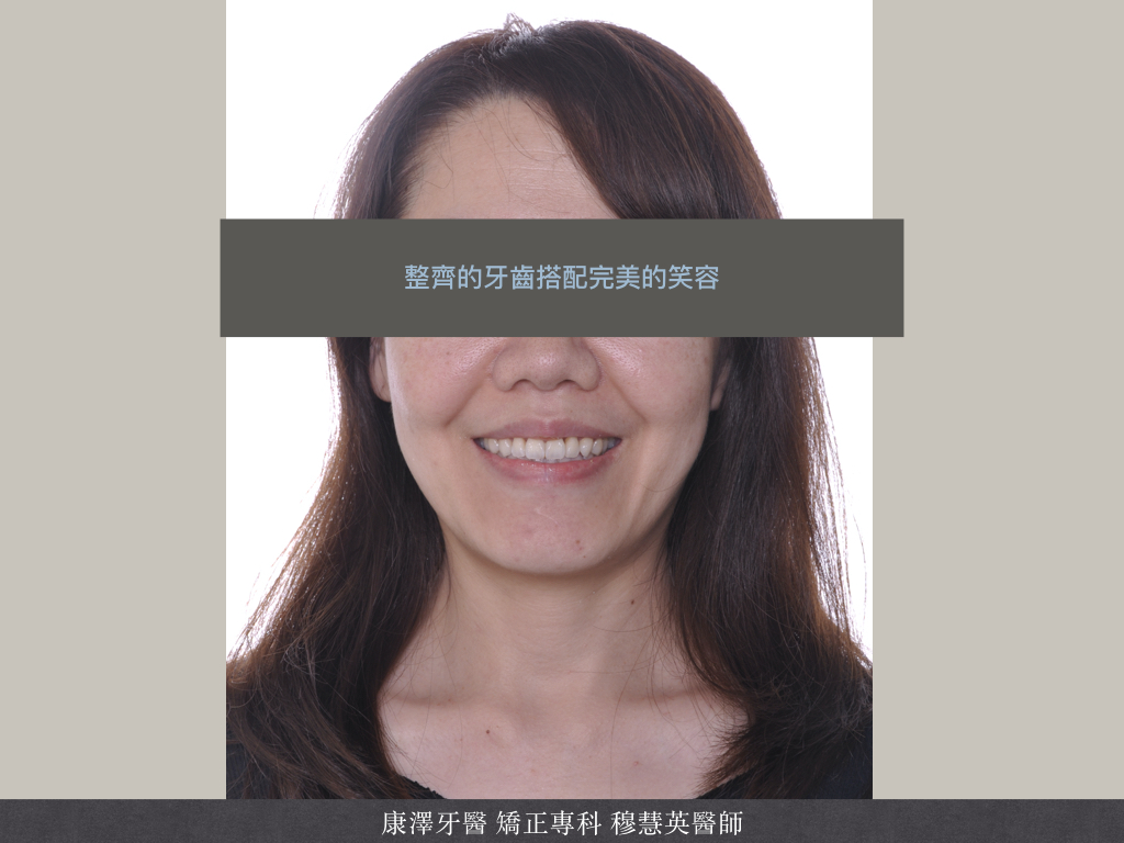 輕微牙齒不整齊?別小看矯正帶來的驚人改變! 輕微牙齒不整齊?別小看矯正帶來的驚人改變!