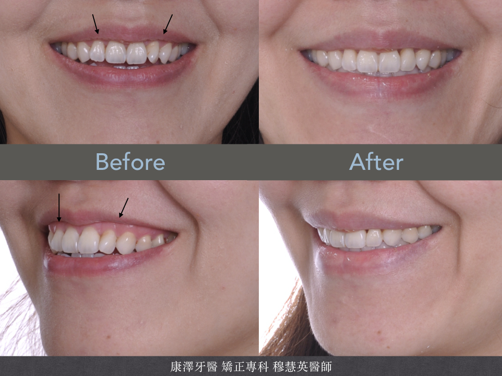 輕微牙齒不整齊?別小看矯正帶來的驚人改變! 輕微牙齒不整齊?別小看矯正帶來的驚人改變!