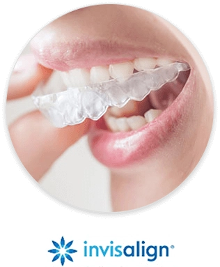 隱適美隱形矯正