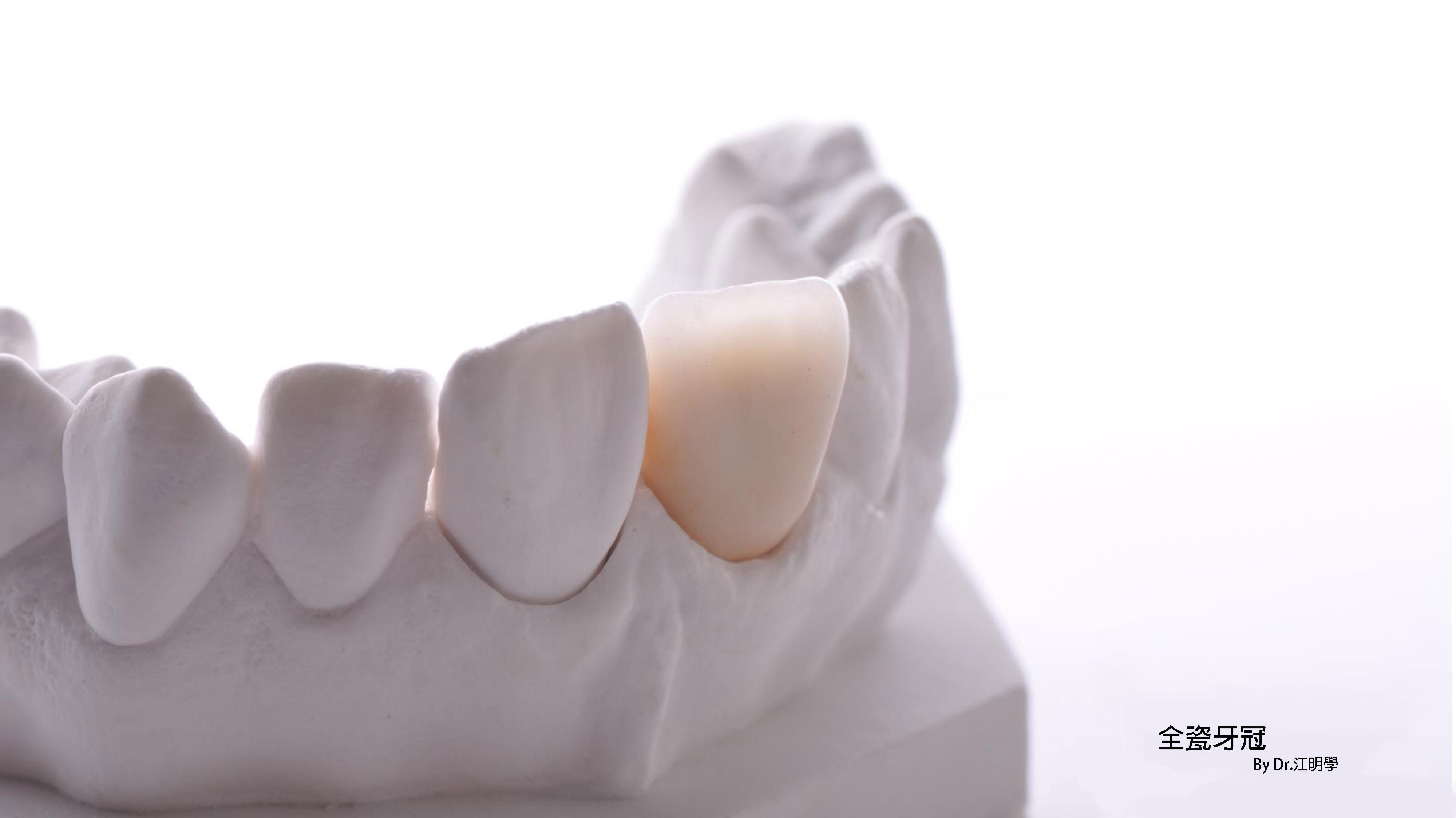 全瓷牙冠 全瓷牙冠
