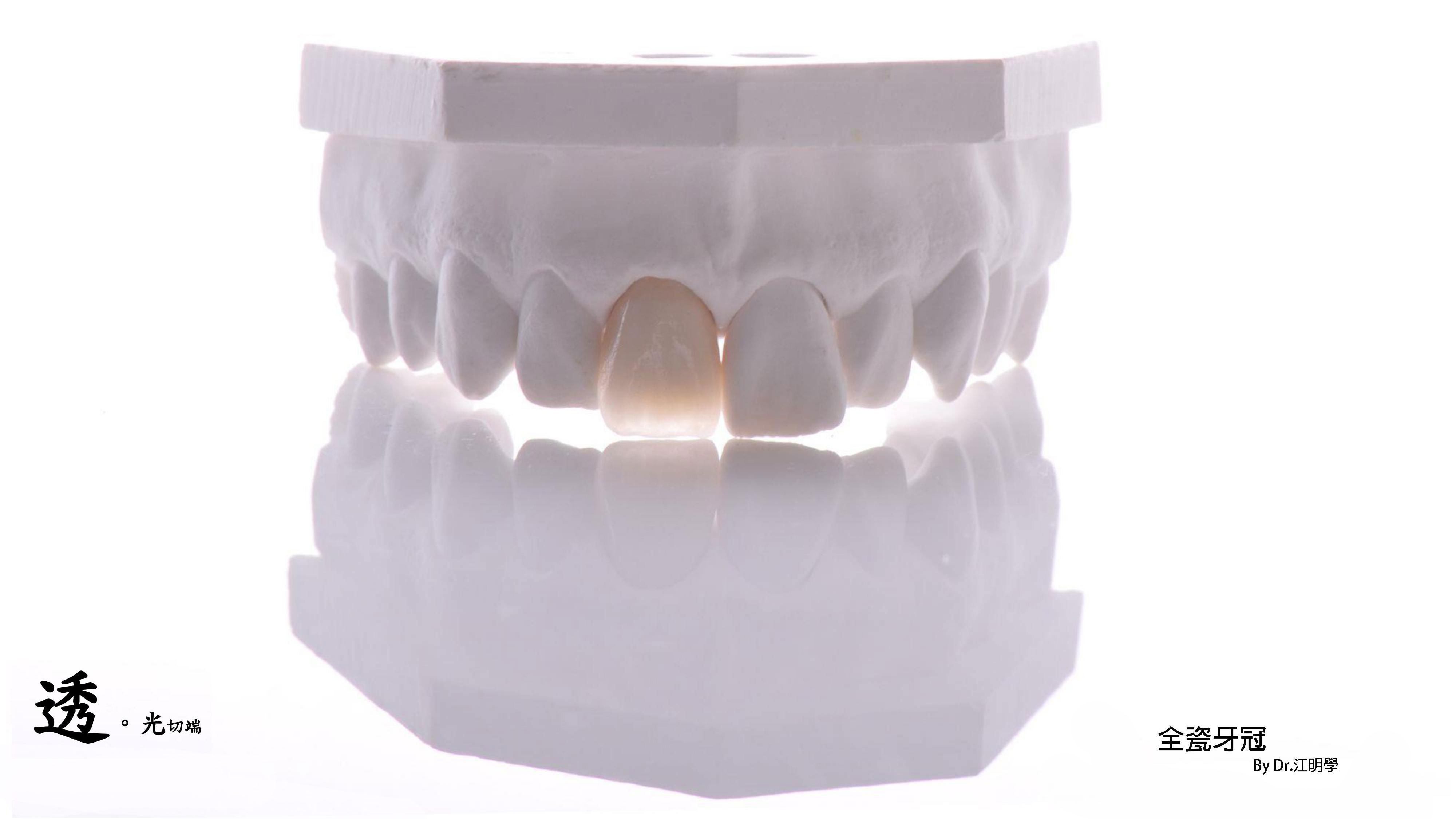 全瓷牙冠 全瓷牙冠