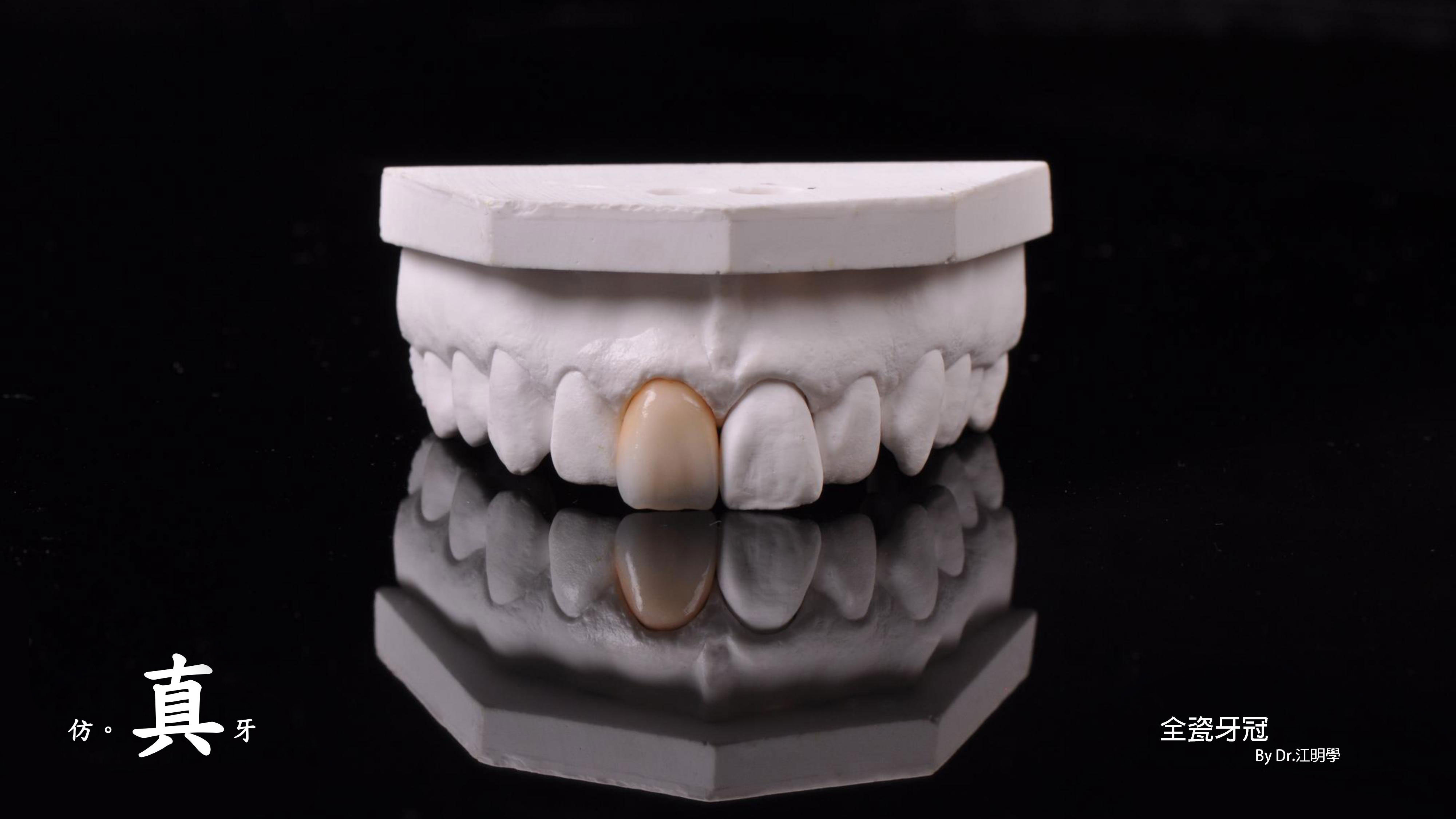 全瓷牙冠 全瓷牙冠