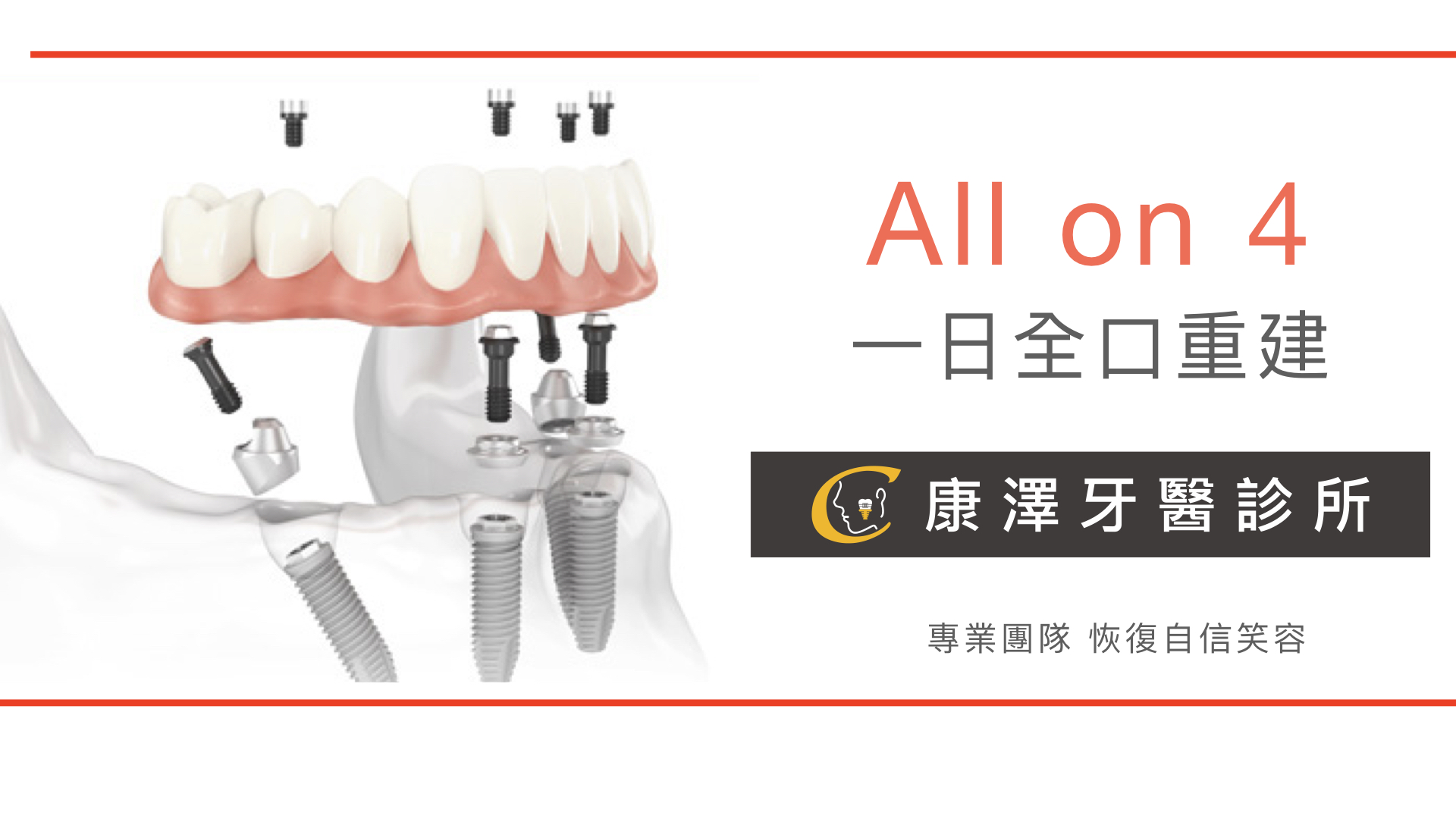 All-on-4 一日全口重建 All-on-4 一日全口重建