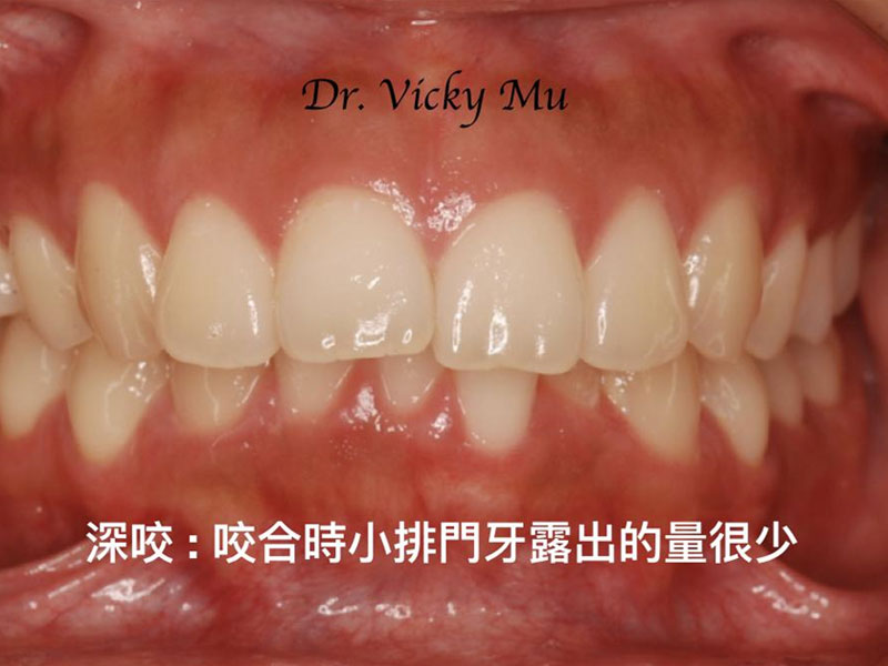 改善暴牙及深咬的案例