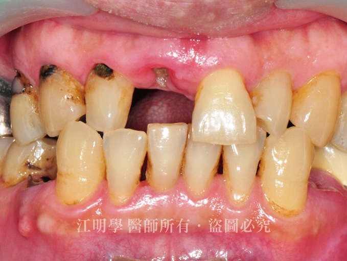 3D導航 DSD 數位微笑設計