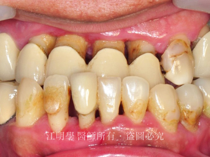 假牙脫落-全口植牙案例