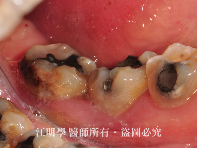嚴重蛀牙植牙案例