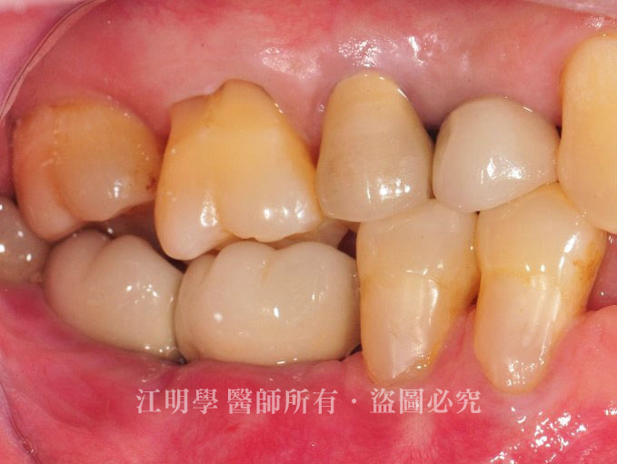 後牙植牙案例