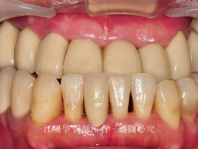 假牙脫落-全口植牙案例