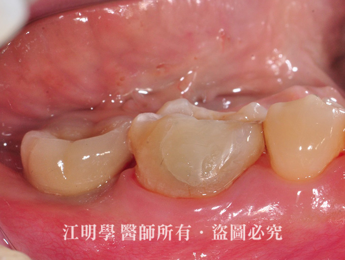 嚴重蛀牙植牙案例