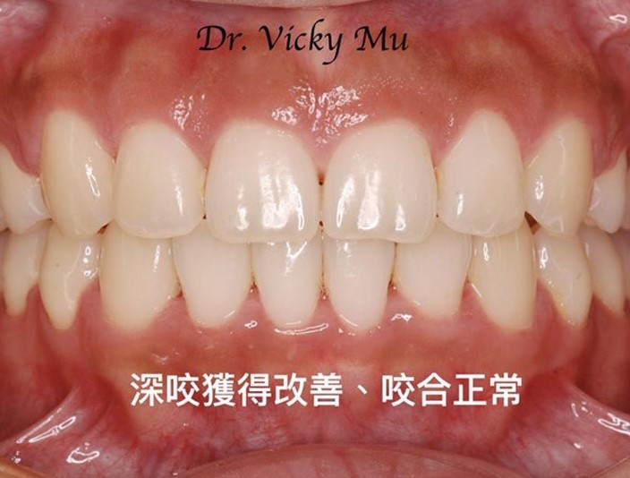 改善暴牙及深咬的案例