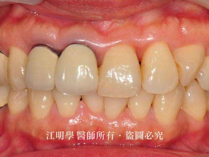 前牙美學＿金屬牙冠造成牙齦黑邊