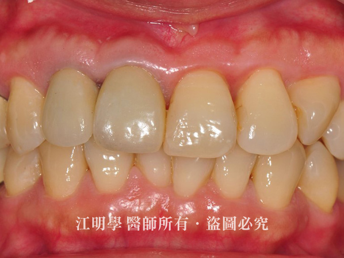 前牙美學＿金屬牙冠造成牙齦黑邊