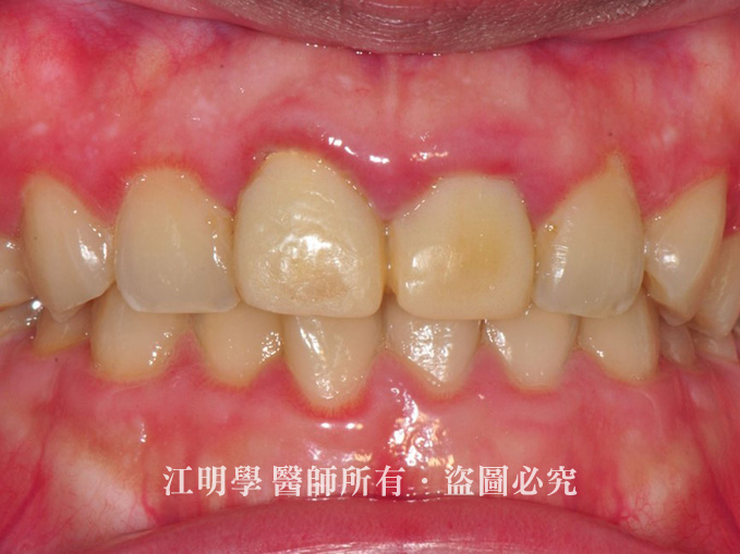 前牙美學_菸垢黃牙