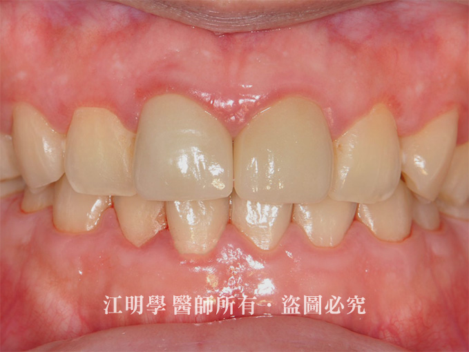 前牙美學_菸垢黃牙