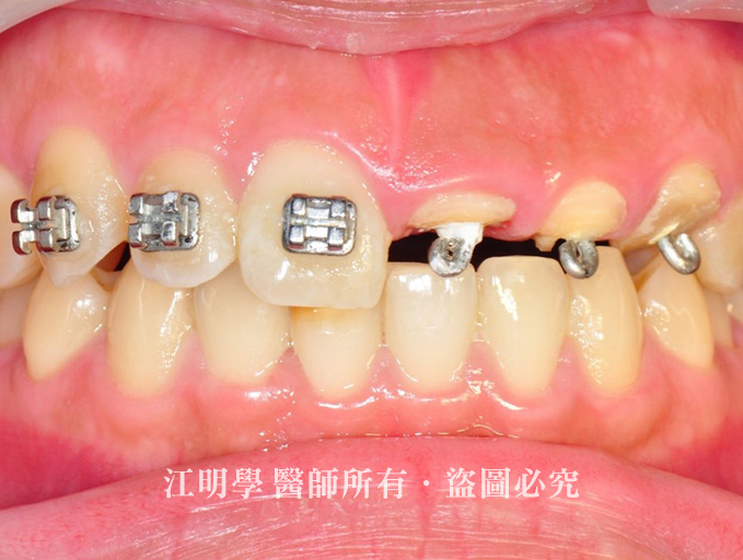 前牙美學_修復斷牙案例