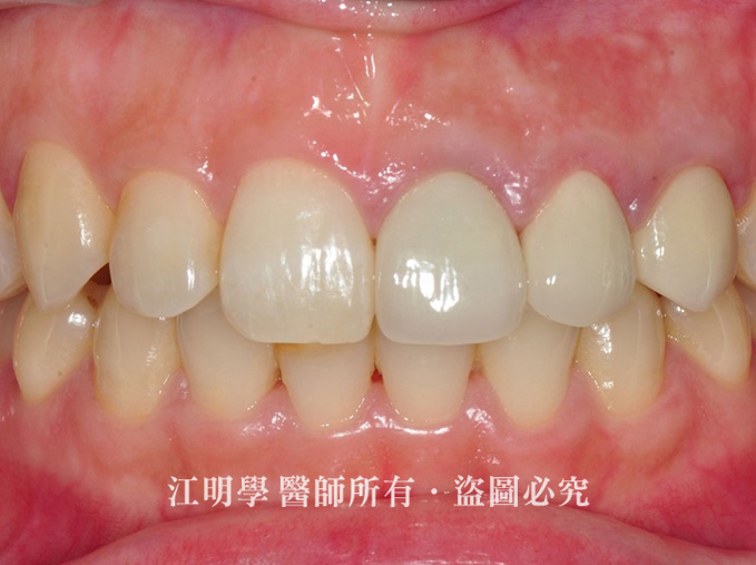 前牙美學_修復斷牙案例
