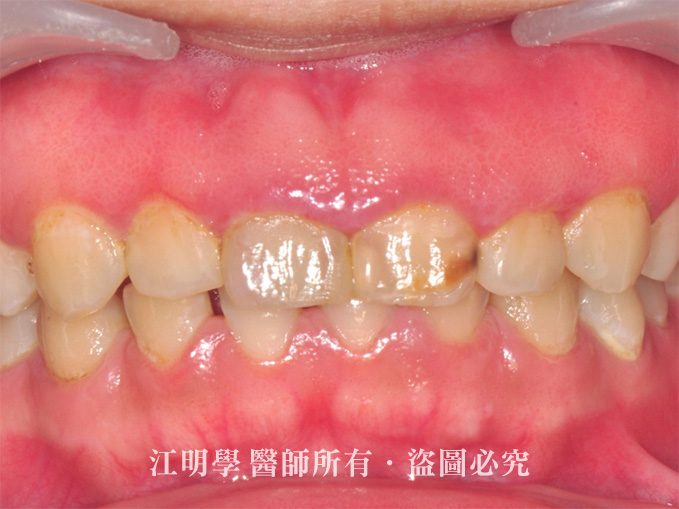 前牙美學_牙冠增長術