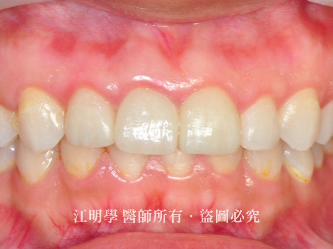 前牙美學_牙冠增長術