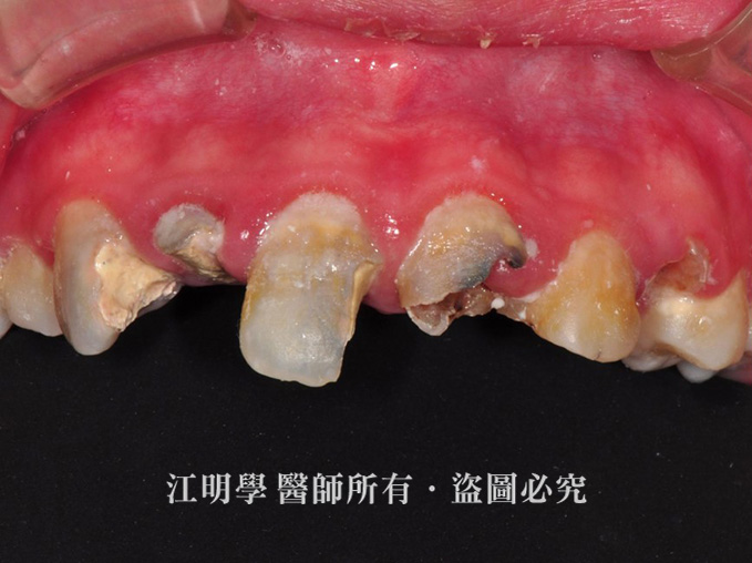 前牙美學_嚴重蛀牙