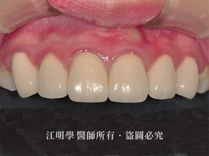 前牙美學_嚴重蛀牙