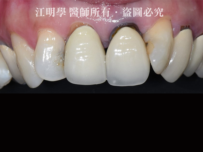 前牙美學_金屬牙冠露出黑邊