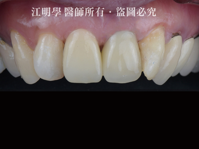 前牙美學_金屬牙冠露出黑邊