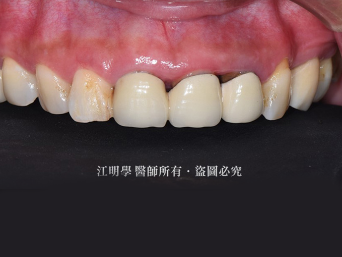 前牙美學_嚴重笑齦