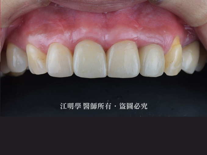 前牙美學_嚴重笑齦