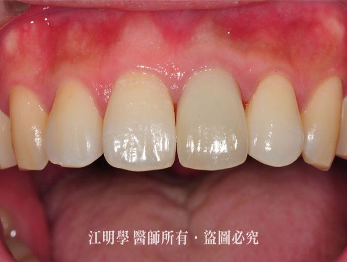 前牙美學＿門牙斷裂案例