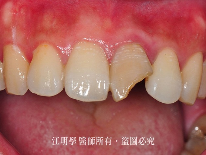 前牙美學＿門牙斷裂案例