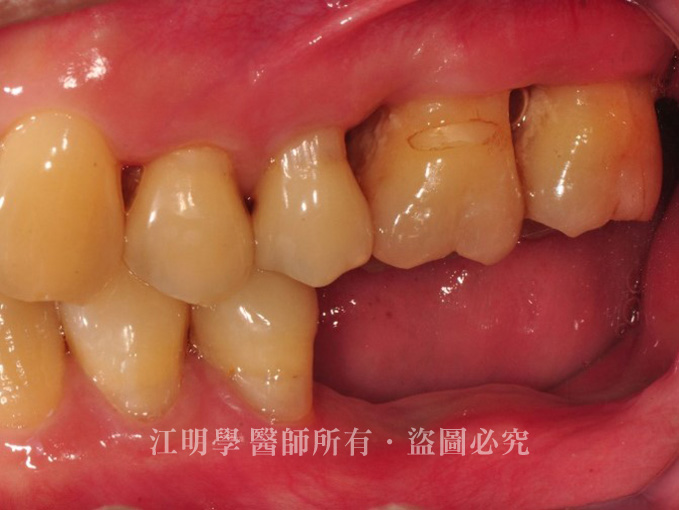 牙周病植牙案例