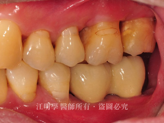 牙周病植牙案例