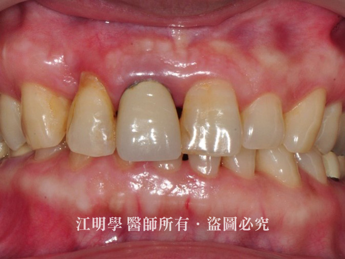 金屬假牙黑邊案例