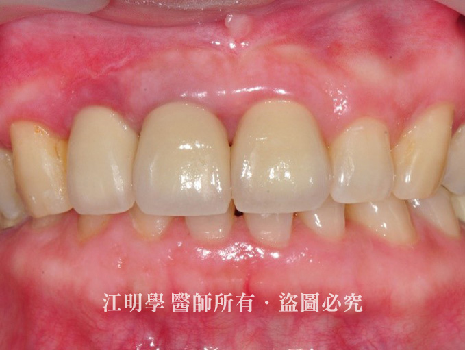 金屬假牙黑邊案例