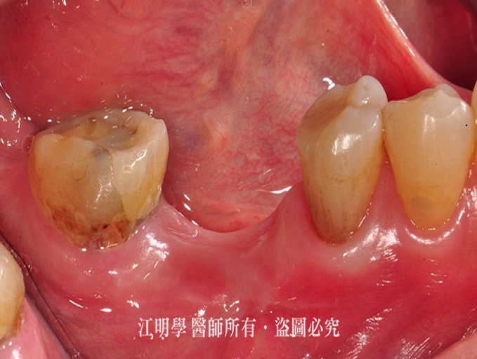 抽菸患者做植牙