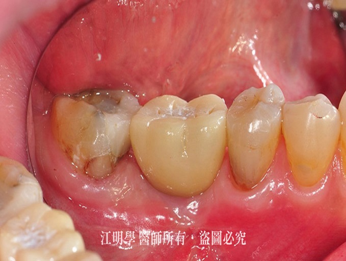 抽菸患者做植牙