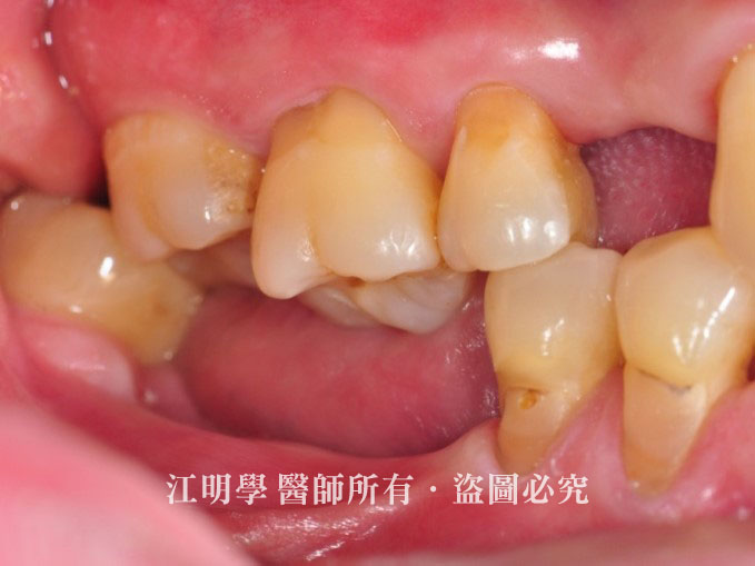 後牙植牙案例