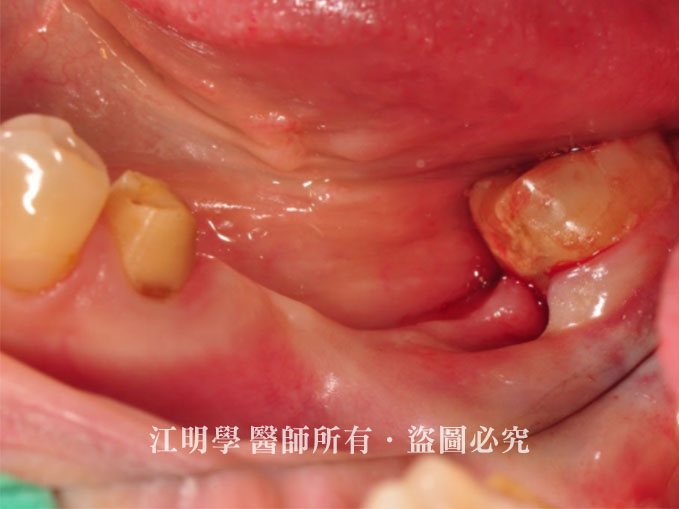 引導骨再生術植牙案例