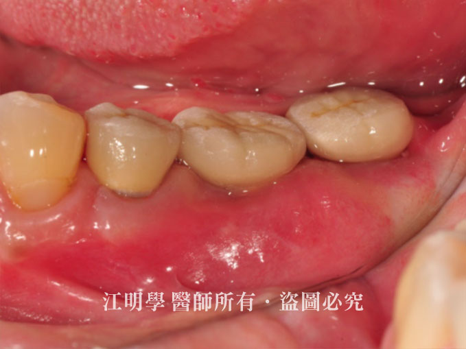 引導骨再生術植牙案例