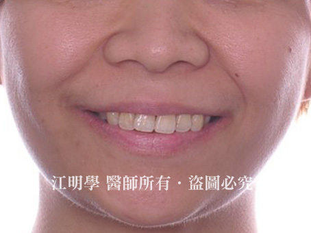 牙周協同矯正治療