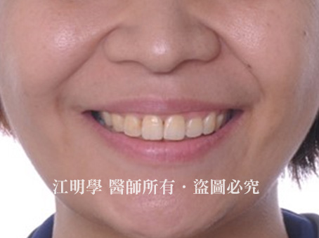 牙周協同矯正治療