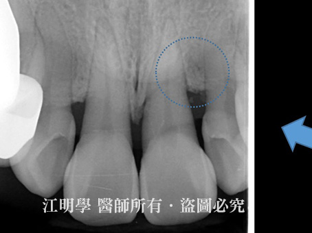 牙周再生手術案例