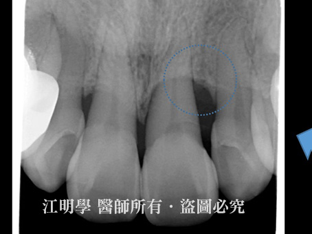 牙周再生手術案例